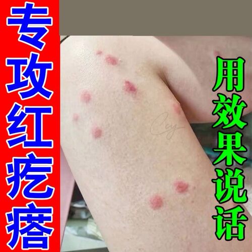 秋冬天冷身上起红疙瘩痒腿部皮肤痒过敏长痘痘小红点膏外用