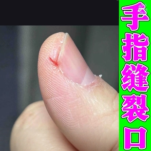 手指头裂口子干裂修复霜秋冬季指甲缝开裂脱皮疼痛防皲裂愈合膏