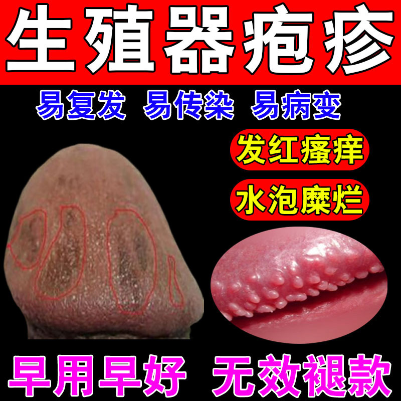 生殖器疱疹用药断治根男女私处病毒感染龟头小水泡龟头炎抗菌药