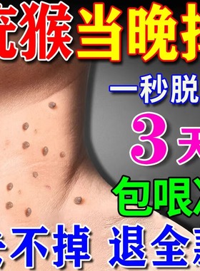扁平疣去除软膏一抹灵去疣尤瘊用根斩草除根祛疣小肉粒药膏医用