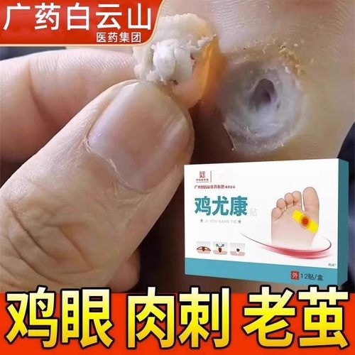 鸡眼贴足部去脚底脚趾手部鸡眼膏