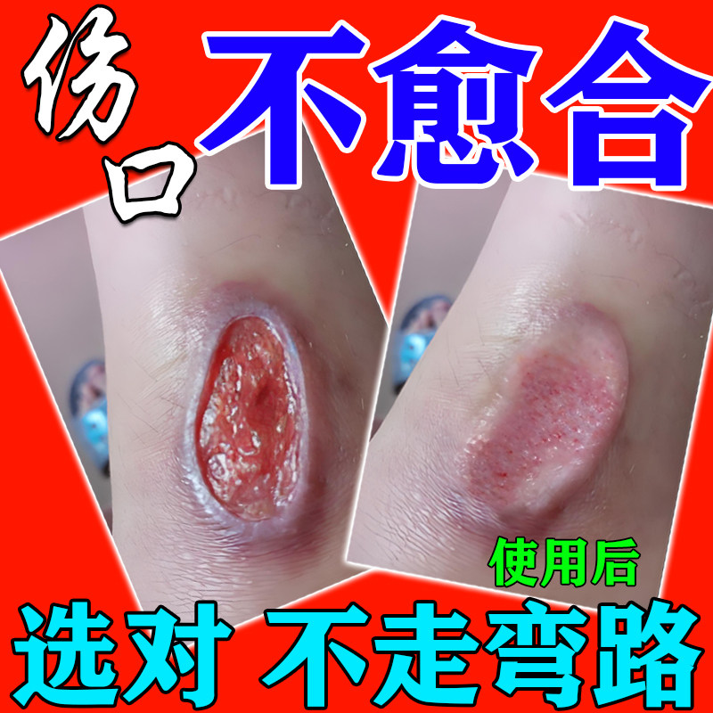 伤口愈合促进长肉伤口炎消杀菌