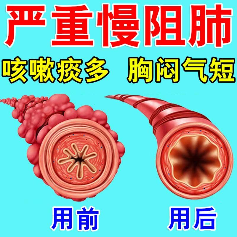 慢阻肺止咳平喘专贴肺气肿呼吸困难胸闷气短哮喘非清肺化痰用药Z