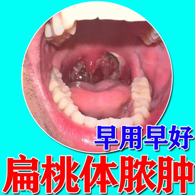 扁桃体脓肿扁桃体反复发炎白斑异物感化脓咽喉肿痛慢性咽炎专用贴
