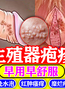 生殖器疱疹断治hsv药男女下体根私处喷剂瘙痒疼痛性病梅毒外用膏