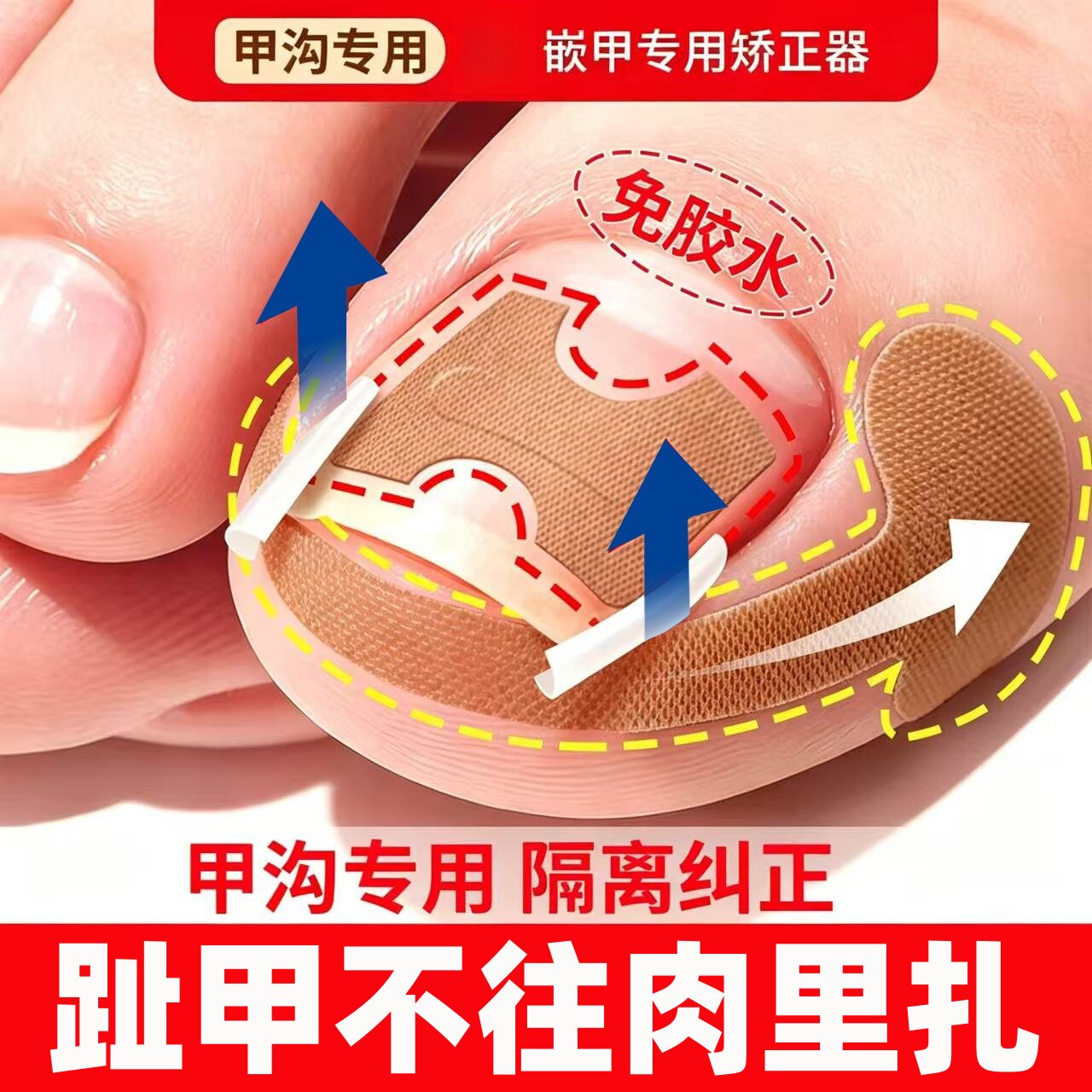 甲沟矫正器正甲贴片神器炎嵌甲矫正器防止趾甲往肉里长专用甲沟垫