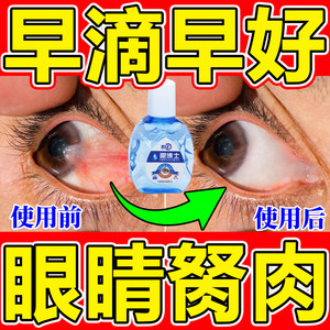 去除眼睛胬肉眼角长翼状胬肉有异物感老是流眼泪迎风流泪滴眼液