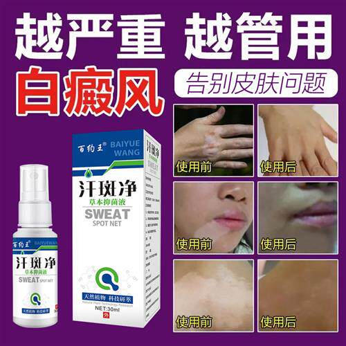 治疗白班外用药膏快速消白斑专用黑色素生长抑菌净白汗斑花斑癣专