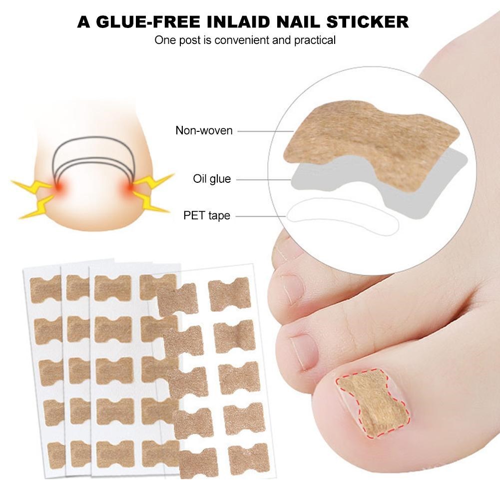 Ingrown Toenail Sticker Nail-Corrector Foot-Care Glue