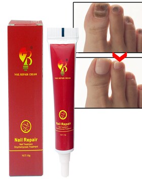 Best Fungus Nail Treatment Cream Onychomycosis Paronychia A