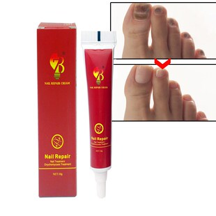Best Fungus Nail Treatment Cream Onychomycosis Paronychia A