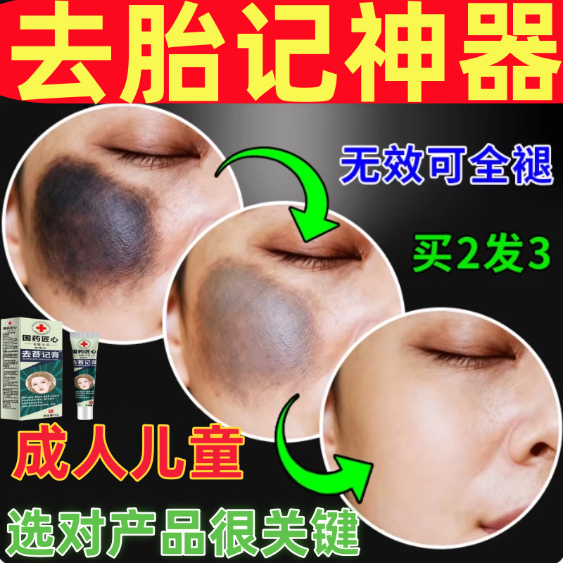 胎记去除神器祛除天生胎记太田痣咖啡斑儿童成人脸部黑色素淡化膏,美容护肤/美体/精油,液态精华,淘宝优惠券,粉丝福利购,淘宝优惠卷
