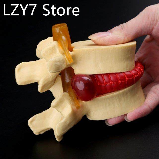 Medical props model Free postage Anatomical Spine Lumbar Dis