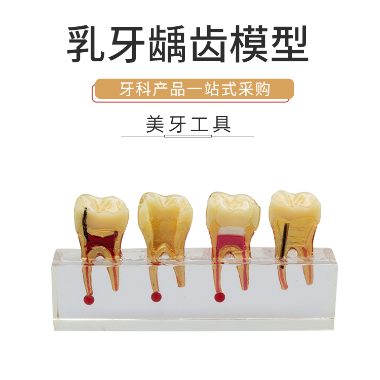 乳牙龋齿模型教学模具