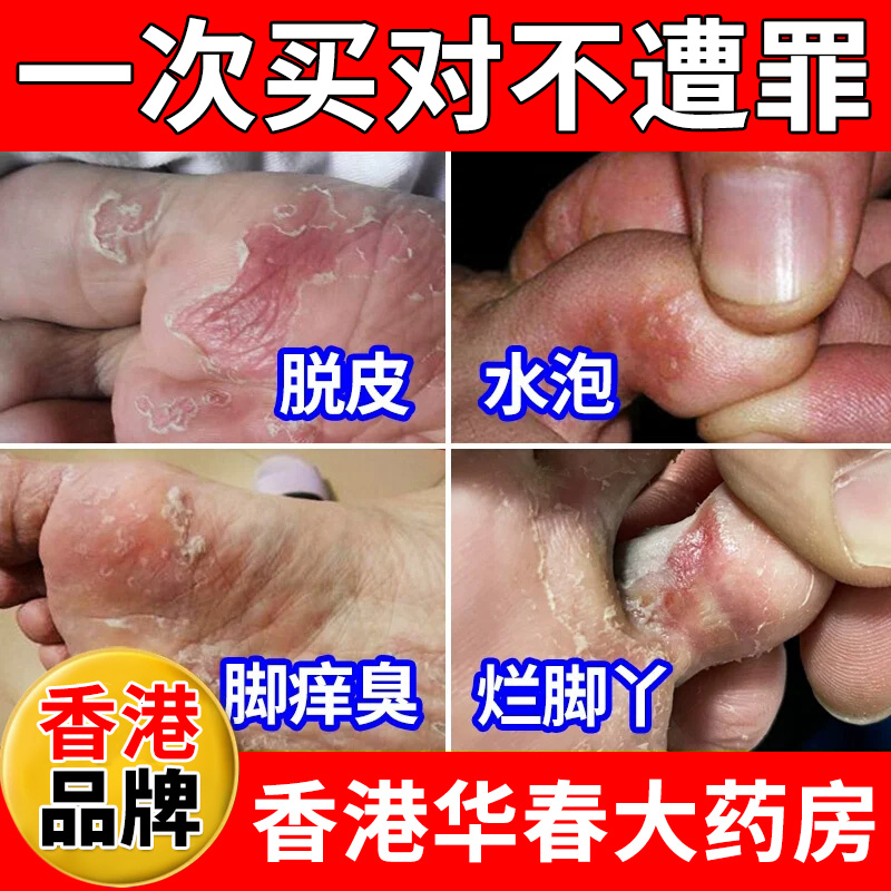 脚气止痒脱皮杀去除真菌感染膏