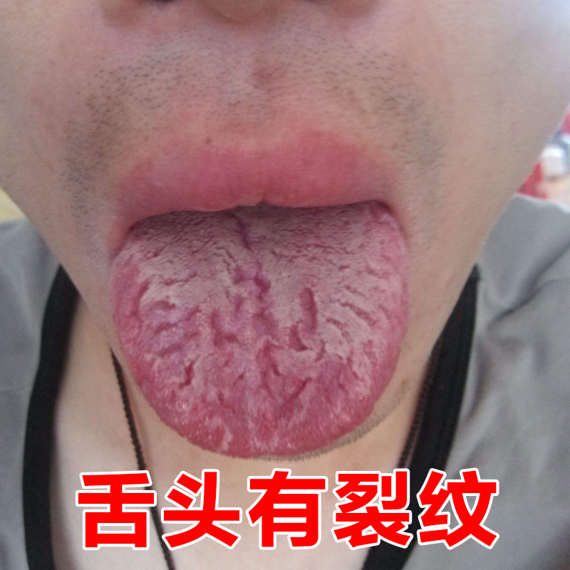 舌头有裂纹舌裂纹舌中裂纹舌头起泡口疮地图舌灼口综合症开裂喷剂