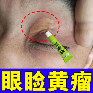 眼睑黄瘤去除膏眼部睑黄瘤脂肪粒眼角黄斑黄色肉块斑块去除眼膏