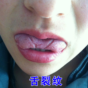 舌裂纹舌头有裂痕灼口综合症地图舌齿痕舌调理舌头疼舌头白厚腻贴