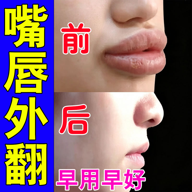 厚嘴唇变薄神器嘴唇太厚外翻香肠嘴改善矫正嘴唇变薄去唇纹护唇膏