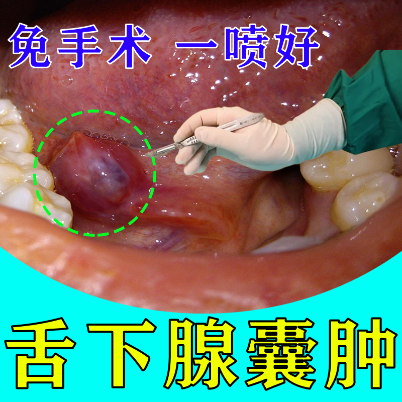 粘液腺囊肿舌下腺囊肿嘴巴里面长脓包肿块导管阻塞淤血异物感修复