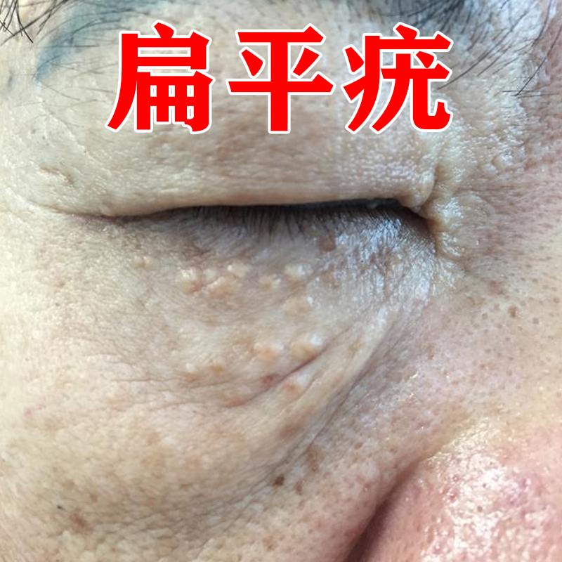 扁平疣去除膏一抹灵扁平疣去除神器脸上有疙瘩疣体汗管瘤脖子专用