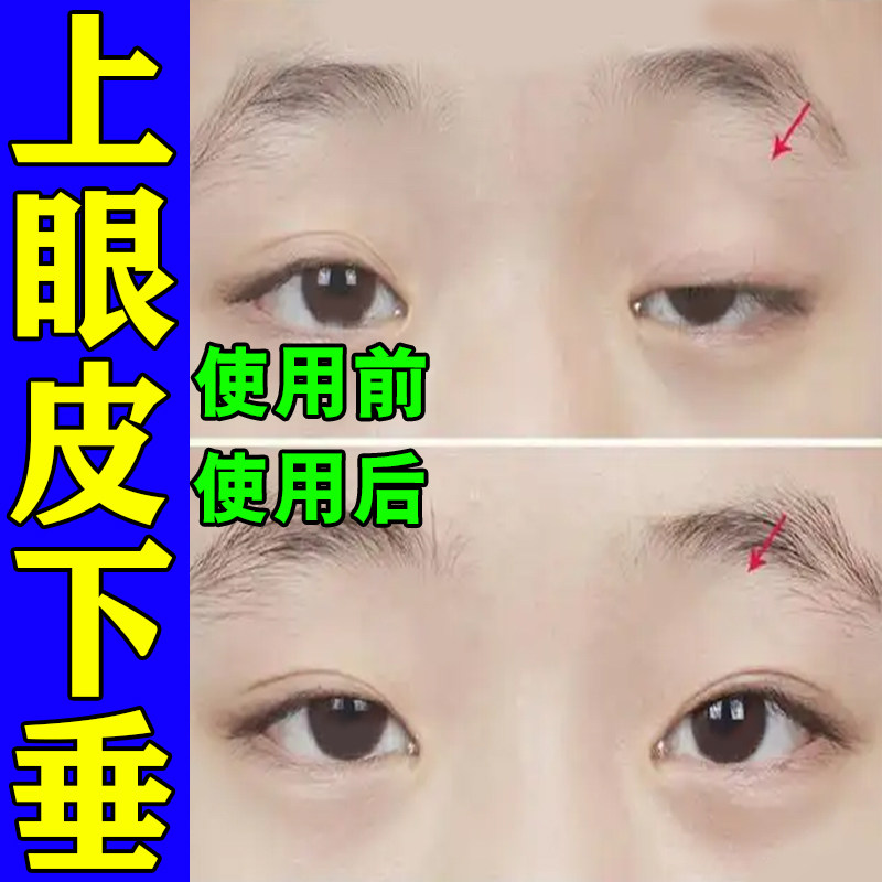 眼皮下垂提拉眼肌无力眼皮松弛睁不开眼眼皮肿胀肿眼泡大小眼去肿
