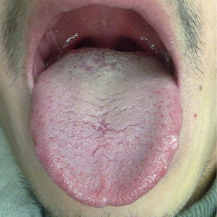 舌苔白厚口臭调理脾胃祛湿舌头发黄齿痕舌口干舌头疼舌裂纹肝火旺