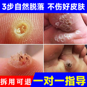 跖忧膏去除病毒拓趾足部根立净去脚底刺非药专寻常膏用正品 神器猴