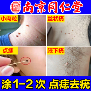 去除猴子专用膏点痣膏无痕正品祛痣药水不留疤黑痣痦子肉粒疙瘩疣
