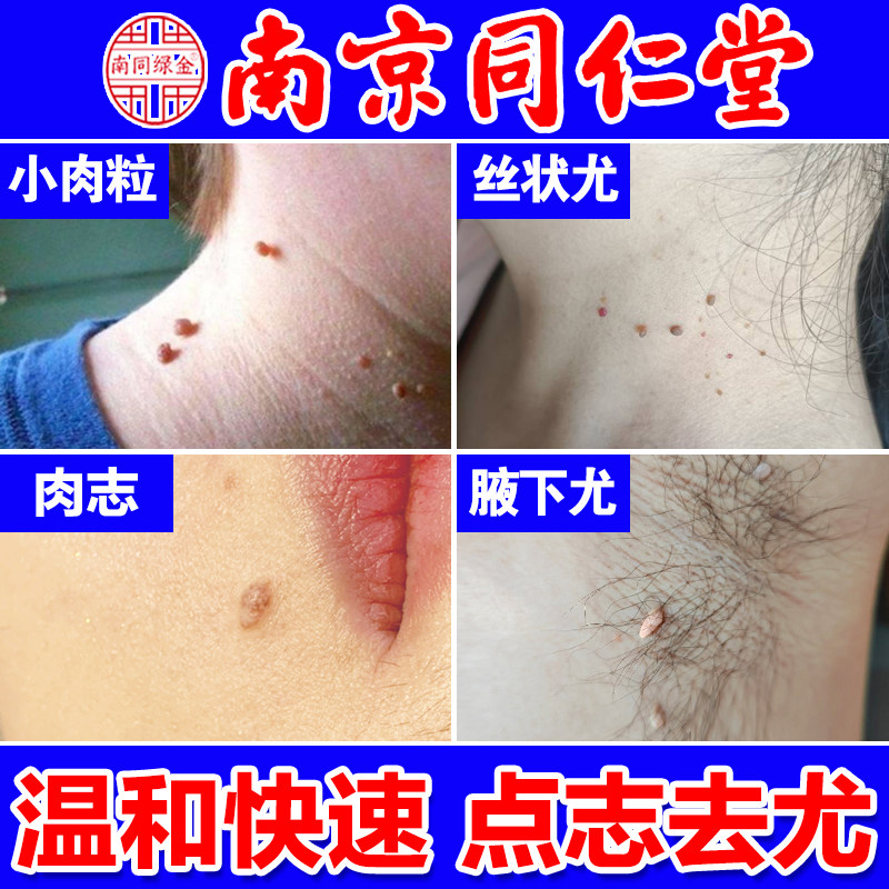 【南京同仁堂】无痕点志去尤