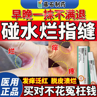 手指缝溃烂开裂烂痒水泡脱皮糜烂搭长期泡水烂手丫脱皮软膏药贴QN