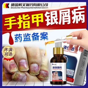 手指甲牛皮癣银屑甲病灰指甲变白增厚空甲脱真菌感染药房同售YF