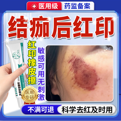 结痂后去红印黑印儿童擦伤摔伤掉痂后除疤痕修复点痣后退红淡印QN