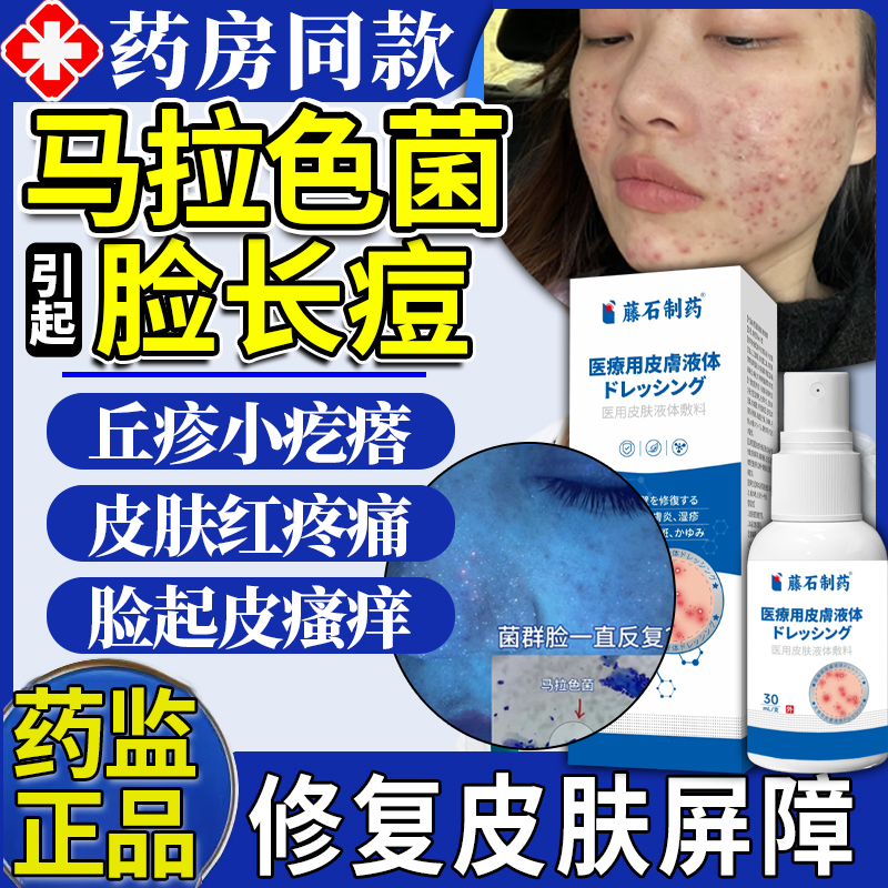 马拉色菌脸部螨虫去脸上痘毛囊炎脂溢性皮炎面部非药膏痤疮喷雾QN
