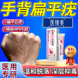 hpv病毒手背扁平疣去除丝状疣瘊子一抹灵药膏可搭干扰素凝胶QN