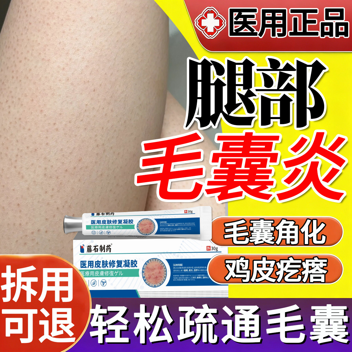 腿部毛囊炎专用腿上有鸡皮疙瘩腿部毛孔堵塞疏通毛囊毛周角化症ZJ