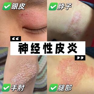 神经性皮炎止痒搭药膏皮肤病癣藓湿疹真菌感染眼皮日本特去效根QN