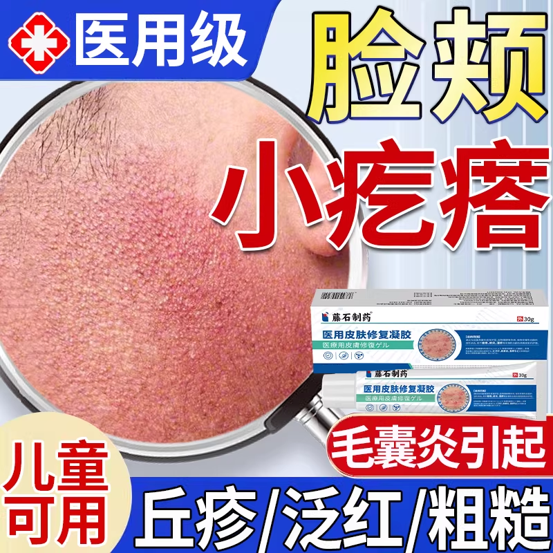 儿童脸颊两边小疙瘩颗粒鸡皮肤泛红面部毛周角化症搭专药面霜用QN