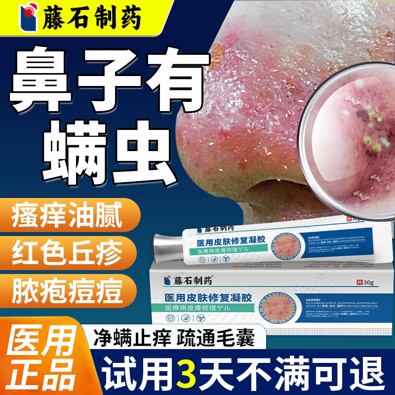 鼻子螨虫痒止痒搭药膏脸部上除螨祛痘黑头粉刺搭酒糟鼻玫瑰痤疮QN