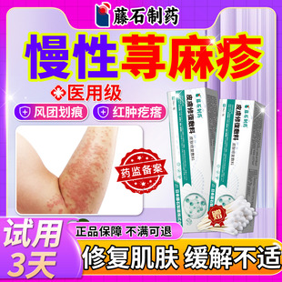 治急慢性寻荨麻疹儿童过敏专止痒断皮肤瘙痒提高免疫力可搭药膏YF