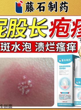 臀部单纯带状疱疹引起屁股反复红斑水泡搭病毒性疼痛膏药房同售QN