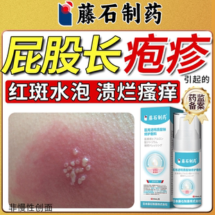 臀部单纯带状疱疹引起屁股反复红斑水泡搭病毒性疼痛膏药房同售QN