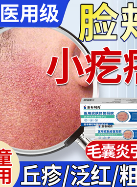 儿童脸颊两边小疙瘩颗粒鸡皮肤泛红面部毛周角化症搭专药面霜用QN