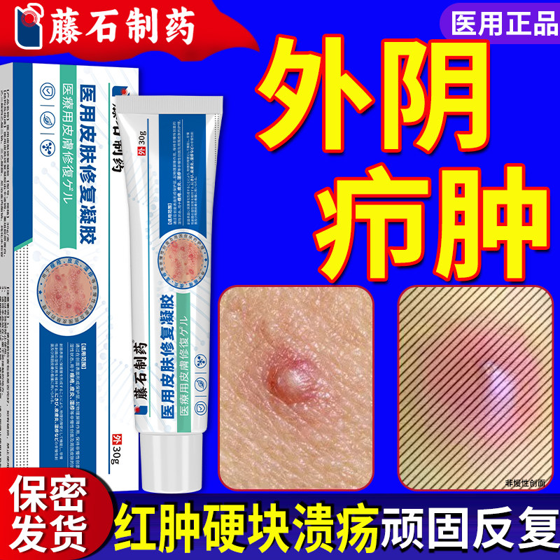 外阴火疖子私处疖肿搭拔毒拔脓药膏屁股长痘皮脂腺囊肿毛囊硬块QN