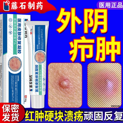 外阴火疖子私处疖肿搭拔毒拔脓药膏屁股长痘皮脂腺囊肿毛囊硬块QN