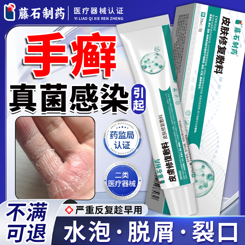手藓手癣真菌感染脱皮干裂鹅掌风角化型水泡型专药膏用开裂水泡QN