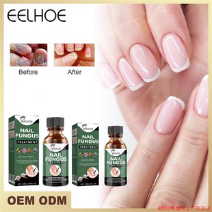 eelhoe NAIL FUNGUS TREATMENT  30ML