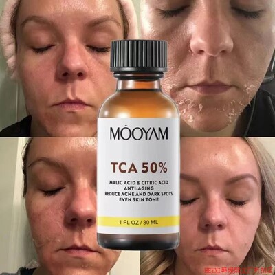 TCA 50% Chemical Peel Tca Peel Acid Skin Superforce Peel