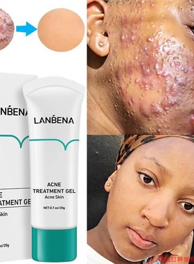 LANBENA Acne Treatment Gel Cream Anti Pimples Spots Scars Re