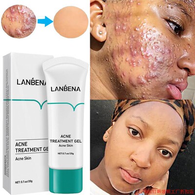 LANBENA Acne Treatment Gel Cream Anti Pimples Spots Scars Re